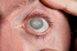A close-up of a person's eye with a severe cataract, possibly caused by eye doctor malpractice. This image highlights the risks of misdiagnosis or surgical errors leading to vision impairment. A close-up of a person's eye with a severe cataract, possibly caused by eye doctor malpractice. This image highlights the risks of misdiagnosis or surgical errors leading to vision impairment.