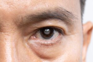 Close-up of a man's eye showing signs of vision impairment, possibly due to surgical mistakes. This image highlights the risks of medical malpractice leading to vision loss. Close-up of a man's eye showing signs of vision impairment, possibly due to surgical mistakes. This image highlights the risks of medical malpractice leading to vision loss.