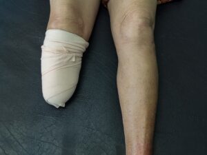 amputation injury chicago amputation injury attorney in Chicago